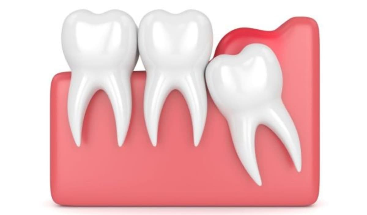 Khi nào cần cắt lợi trùm để tránh biến chứng nguy hiểm?