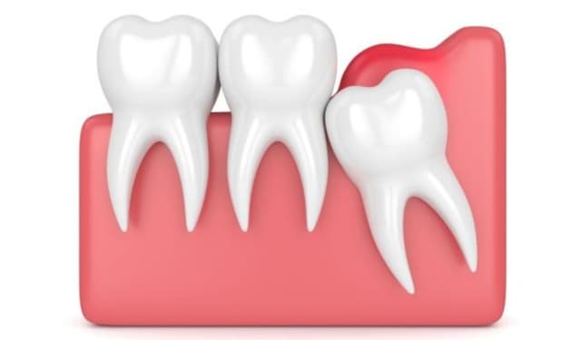 Khi nào cần cắt lợi trùm để tránh biến chứng nguy hiểm?