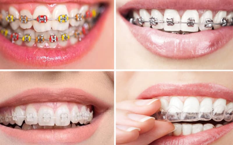 trẻ em Nên niềng răng hay bọc sứ