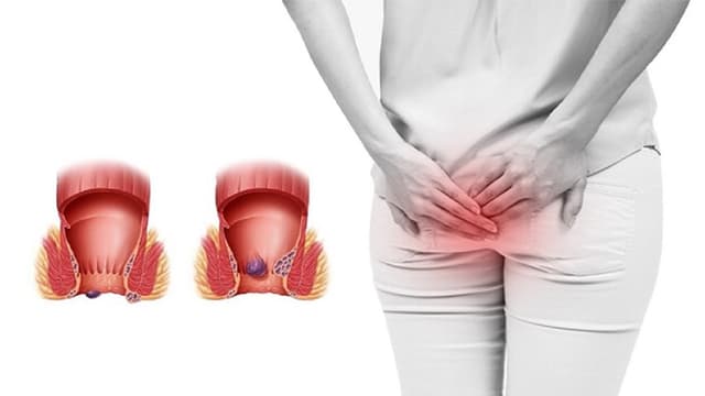 Bệnh trĩ có mấy cấp độ: Phân loại và nhận biết chính xác