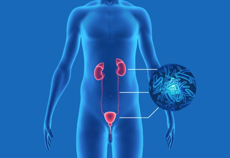 Hậu quả của giãn đài bể thận: Những biến chứng không thể xem nhẹ