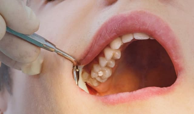 Nhổ răng hàm trên: Quy trình, chi phí và những điều cần biết