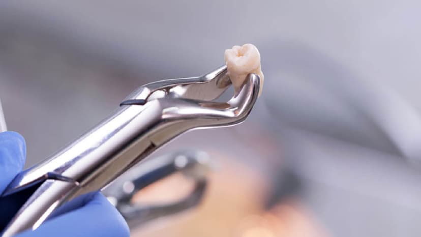 Giải đáp về việc nhổ răng khôn số 8 có nguy hiểm không