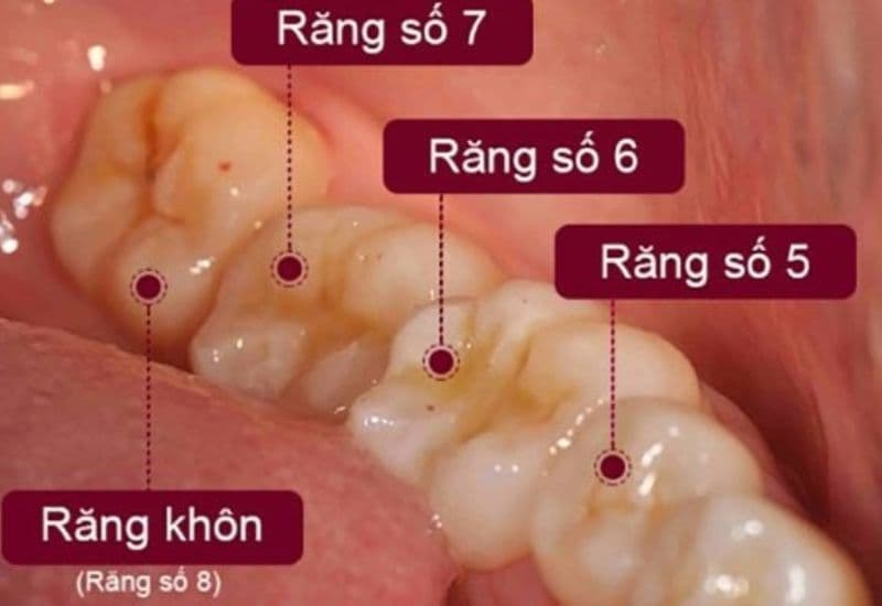 Nhổ răng số 7 là lựa chọn phù hợp khi răng bị tổn thương nặng do sâu.