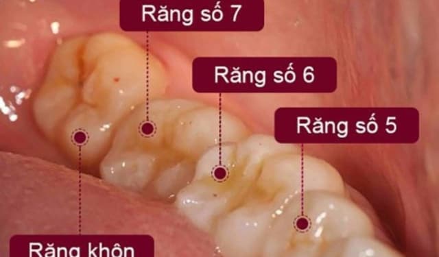 Những điều cần biết trước khi quyết định nhổ răng số 7