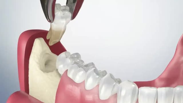 Tìm hiểu nhổ răng số 8 bao lâu thì lành