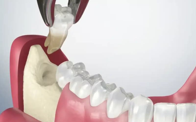 nhổ răng số 8 bao lâu thì lành thương