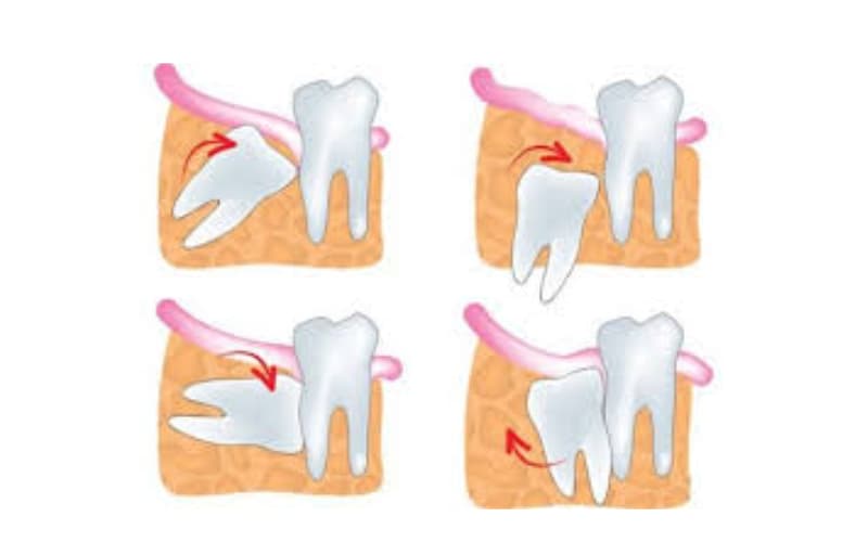 nhổ răng số 8 bao lâu thì lành hẳn