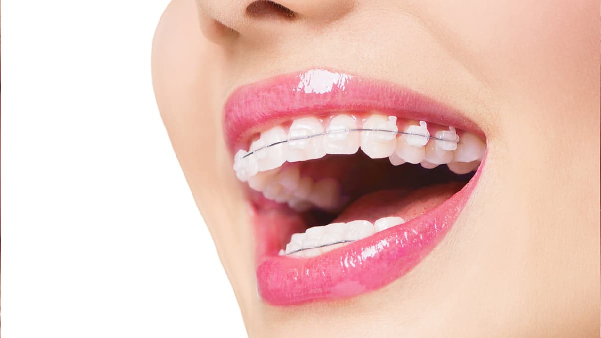 Niềng răng có đau không và những vấn đề liên quan