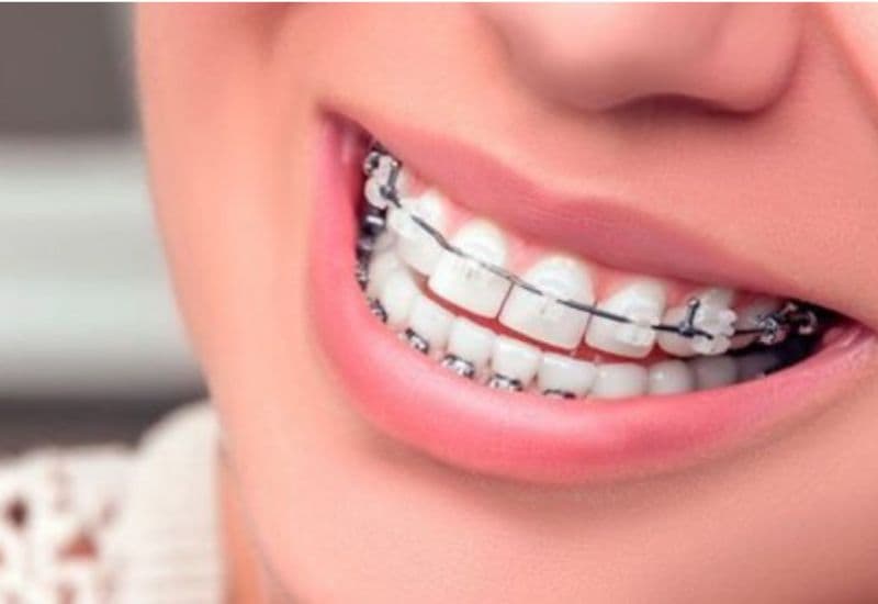 Niềng răng cửa giúp chỉnh sửa răng bị hô, thưa, lệch hoặc khấp khểnh nhẹ.