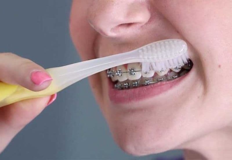 Chăm sóc và vệ sinh đúng cách sau khi niềng răng cửa là yếu tố then chốt để đạt kết quả tốt nhất.