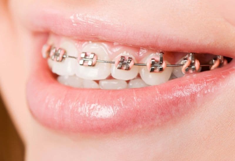 Niềng răng hàm trên thường dành cho trường hợp sai lệch răng trên khi hàm dưới ổn định hoặc không cần chỉnh.