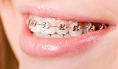 Lợi ích và quy trình niềng răng hàm trên không cần nhổ răng