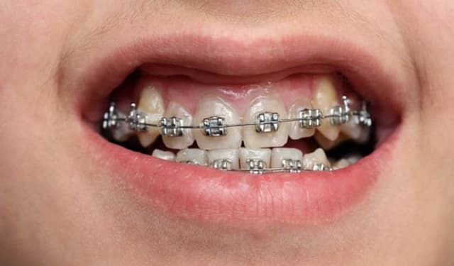 Lợi ích khi niềng răng khểnh và cách chăm sóc sau chỉnh nha