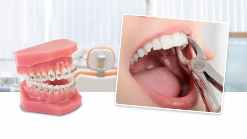 niềng răng không nhổ răng có được không