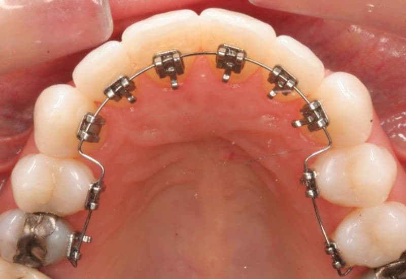 Niềng răng kim loại mặt trong mang lại hiệu quả chỉnh nha cao mà vẫn giữ được tính thẩm mỹ.