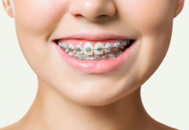 iềng răng mắc cài được ưa chuộng bởi tính hiệu quả và chi phí hợp lý.