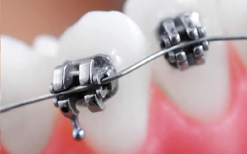 Niềng răng mắc cài tự buộc là gì