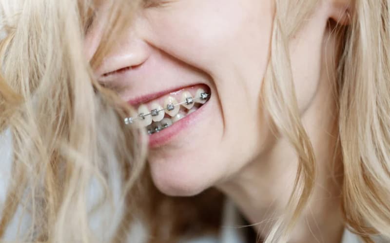 các cách Niềng răng mắc cài tự buộc