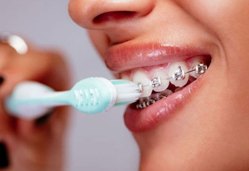 Chăm sóc sau niềng đúng cách giúp kết quả điều trị đạt hiệu quả tối ưu và giữ vững theo thời gian.