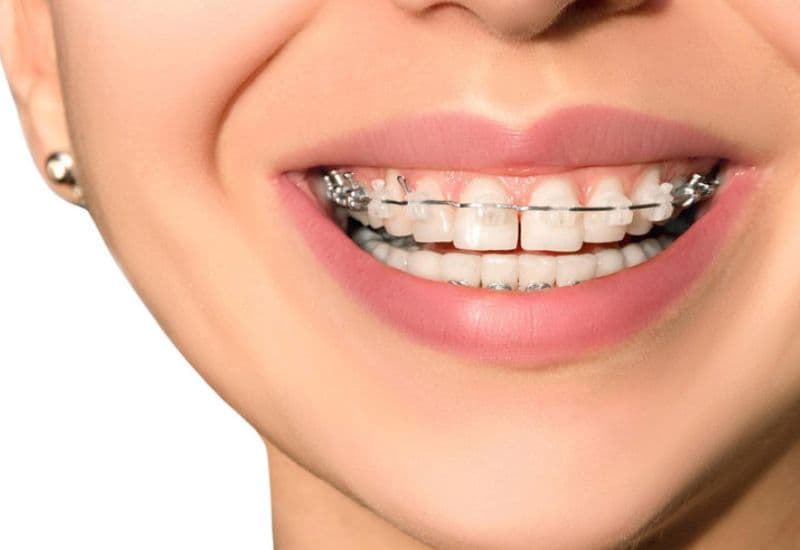 Niềng răng thưa là giải pháp thẩm mỹ được nhiều người tin chọn.