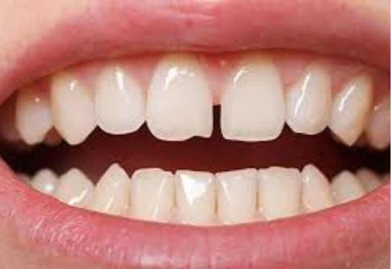 Với người gặp tình trạng răng thưa, khe hở, niềng răng trong suốt là lựa chọn tối ưu để cải thiện nụ cười.