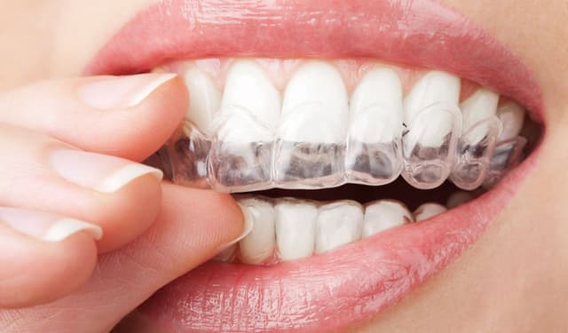 7 Ưu điểm vượt trội của phương pháp niềng răng trong suốt