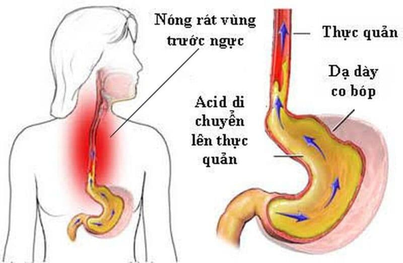 Trào ngược dạ dày là một nguyên nhân phổ biến gây nóng rát và đau tức vùng ngực.