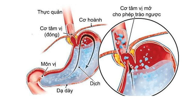 Chứng nuốt nghẹn về đêm có thể do bệnh trào ngược dạ dày thực quản gây ra.