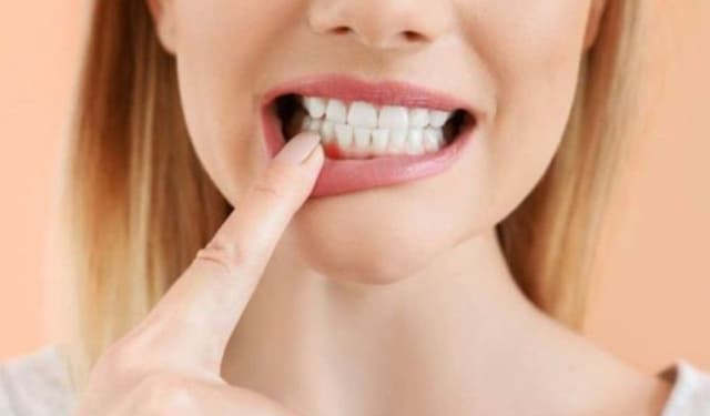 Nướu răng là gì? Cấu tạo, vai trò và những bệnh lý phổ biến