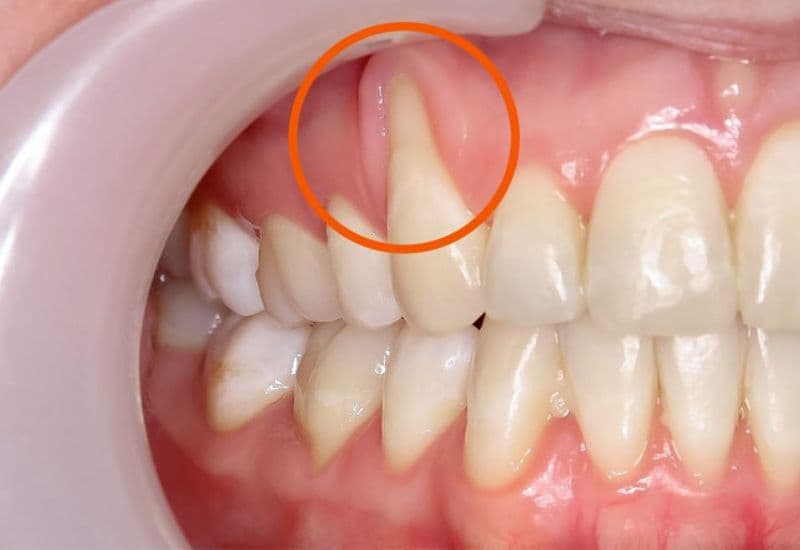 ụt lợi được xem là một trong những hậu quả thường gặp khi nướu răng bị viêm kéo dài.