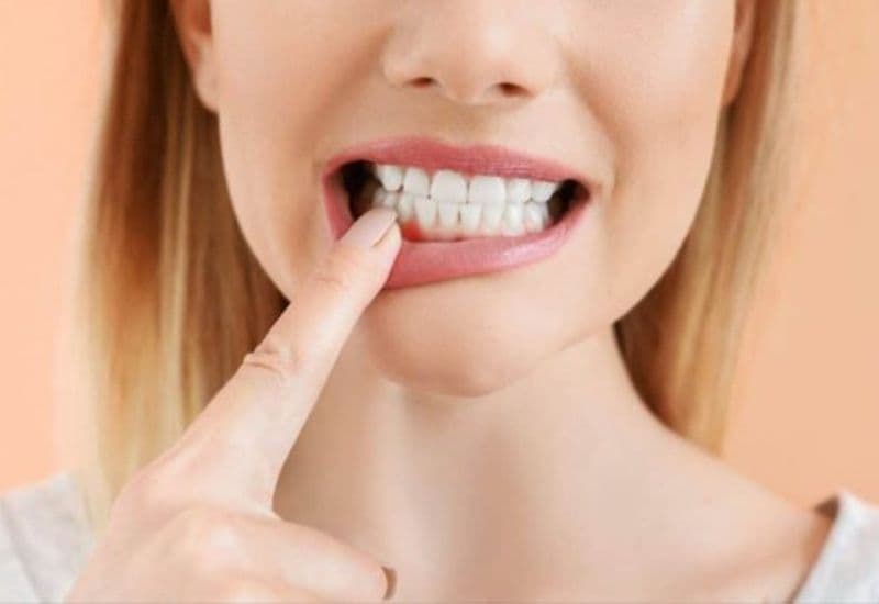 Nướu là mô mềm trong miệng, nằm quanh chân răng và trải dài lên phần xương hàm bên dưới.