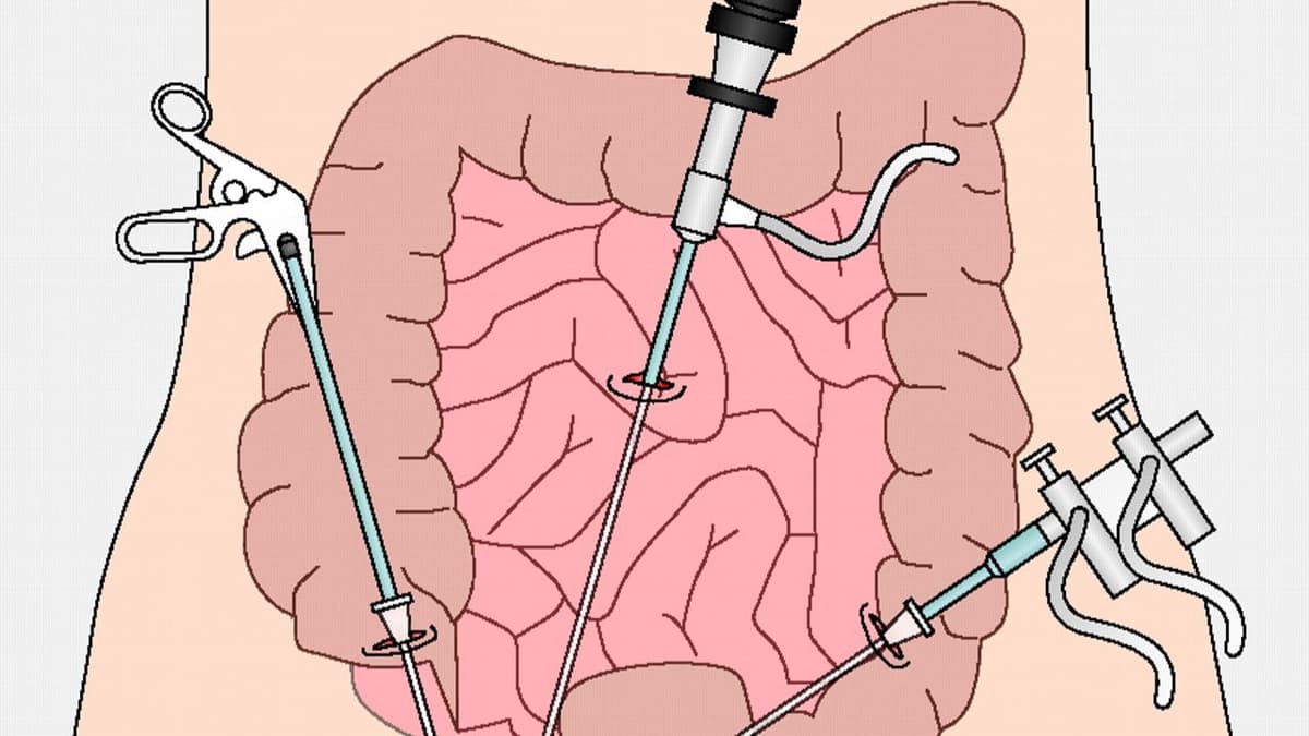 Phẫu thuật điều trị ung thư đại tràng khi nào và lưu ý sau mổ