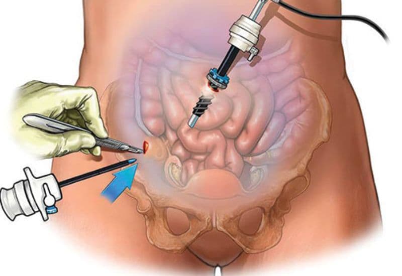 Các phương pháp phẫu thuật ung thư đại tràng phổ biến hiện nay