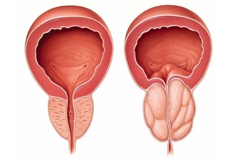 Nguyên nhân gây thận ứ nước ở người lớn cần chú ý