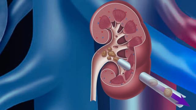 Phương pháp tán sỏi laser qua da: Giải pháp trị sỏi lớn hiệu quả