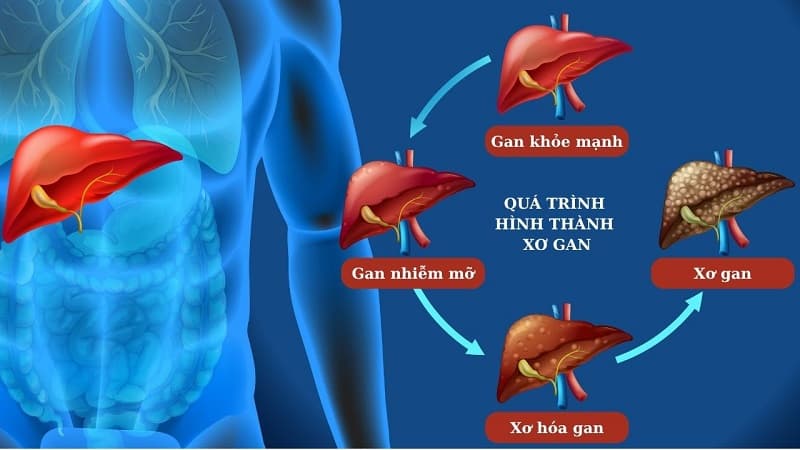 Xơ gan giai đoạn đầu biểu hiện như thế nào?