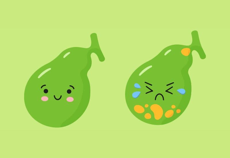 Nguyên nhân sỏi mật do rối loạn chuyển hóa