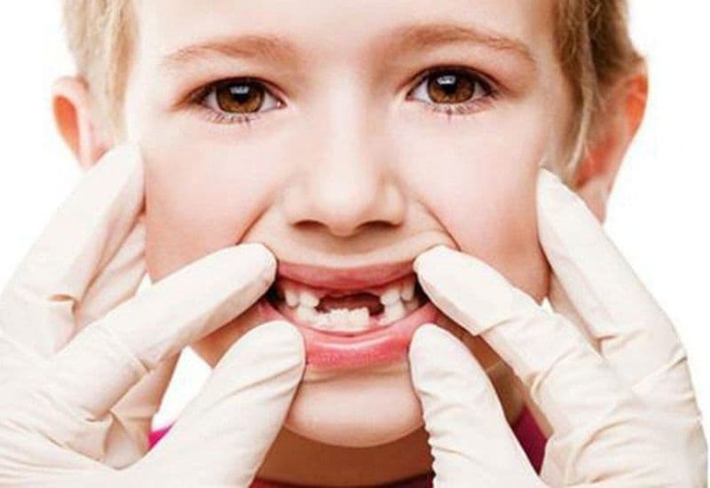 Việc bé bú bình và không được làm sạch răng miệng kỹ lưỡng dễ gây sâu răng em bé.