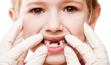 Nguyên nhân và cách phòng tránh sâu răng em bé hiệu quả