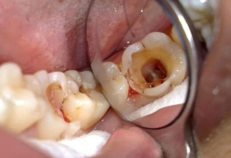 Nếu chậm điều trị, sâu răng hở tủy có thể dẫn đến viêm tủy, áp xe và mất răng.