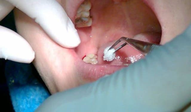 Sâu răng khôn: Dấu hiệu nhận biết và cách phòng ngừa