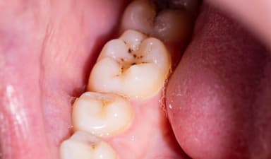 Sâu răng nhẹ: Triệu chứng thường gặp và giải pháp điều trị kịp thời