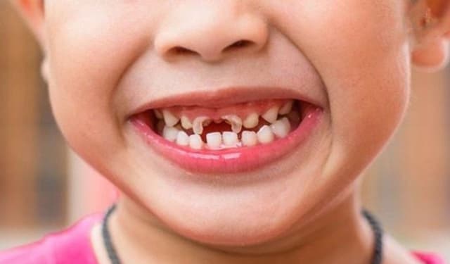 Dấu hiệu nhận biết và giải pháp xử lý sâu răng sữa kịp thời