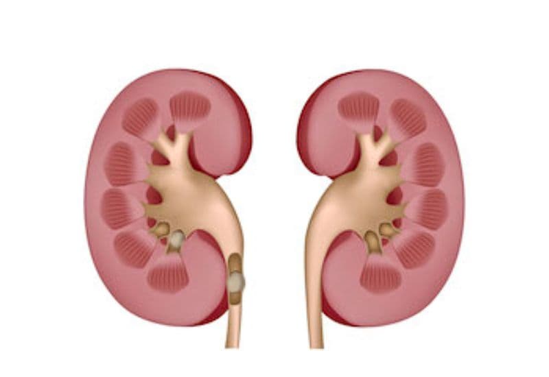 Cơ chế hình thành thận ứ nước độ 1 có sỏi