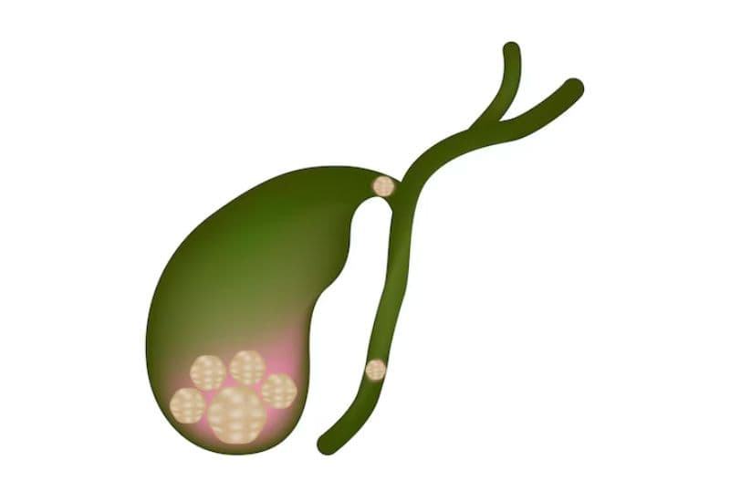 Sỏi mật có nguy hiểm không? Câu trả lời phụ thuộc vào chẩn đoán và điều trị đúng lúc