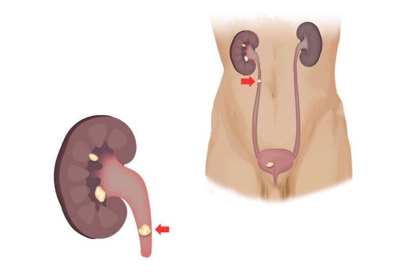 Cơ chế gây ra giãn đài bể thận ở người lớn từ sỏi niệu quản