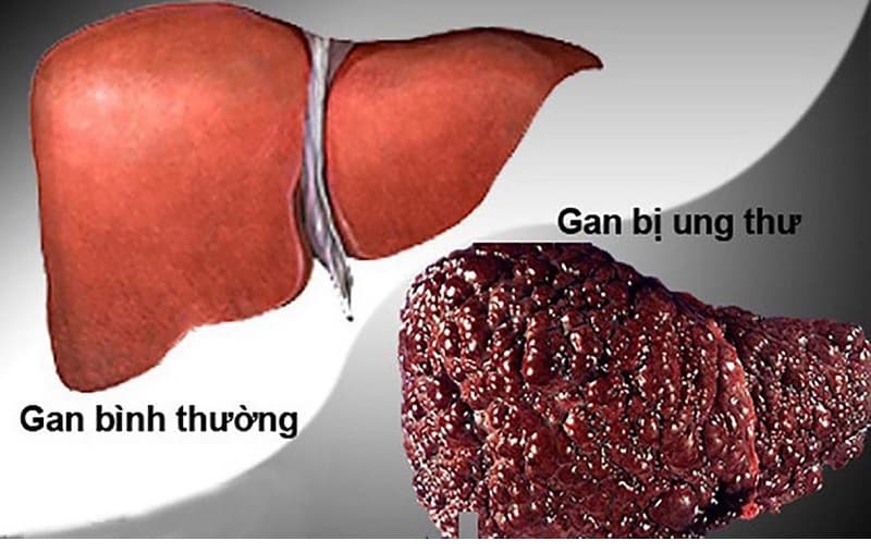 Ung thư gan là một trong những loại ung thư nguy hiểm nhất hiện nay, được chia thành hai nhóm chính là ung thư gan nguyên phát và ung thư gan thứ phát