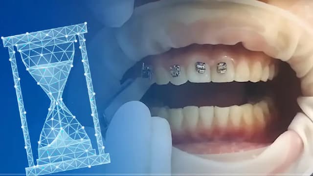 Chi tiết thời gian niềng răng với từng đối tượng cụ thể