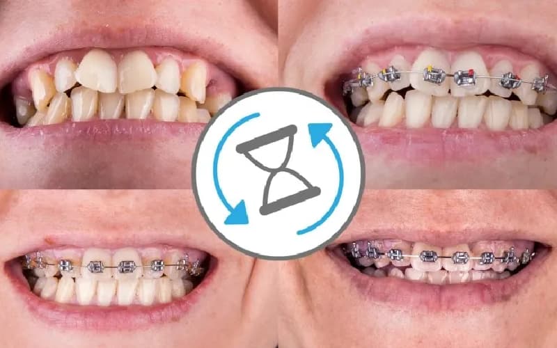 thời gian niềng răng mắc cài